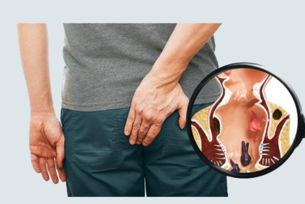 치핵 원인 증상 자연 치료