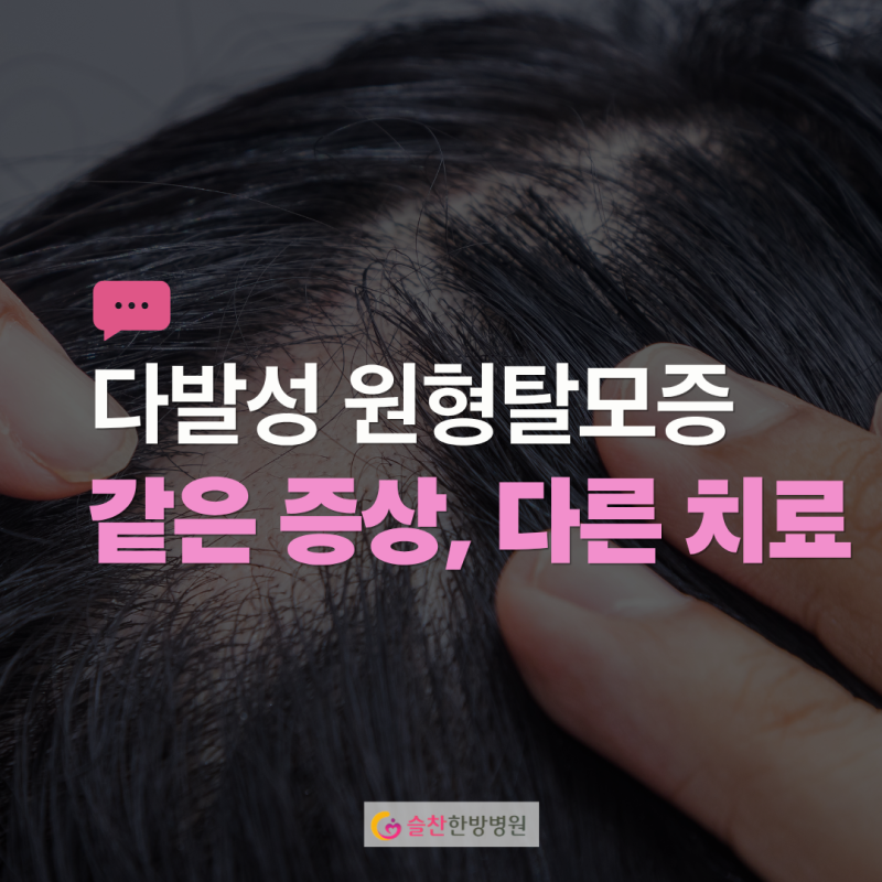 다발성 원형탈모증치료 병원에서 같은 증상이지만 치료는 다 다릅니다.