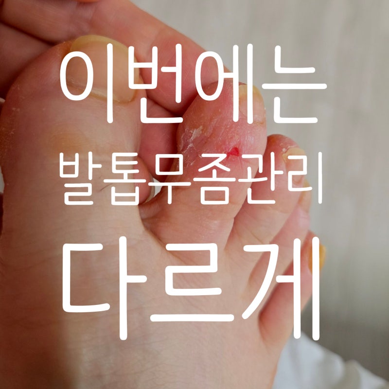 여름마다 반복되는발톱무좀 관리 '큐리젠 토탈솔루션'으로다르게 해봤어요