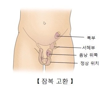 아기 잠복고환 원인과 수술 골든타임, 수술예약까지