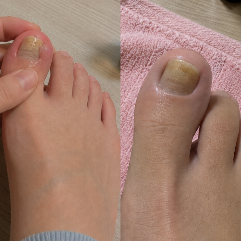 발톱 연화제 사용법과 효과 내성발톱 관리법