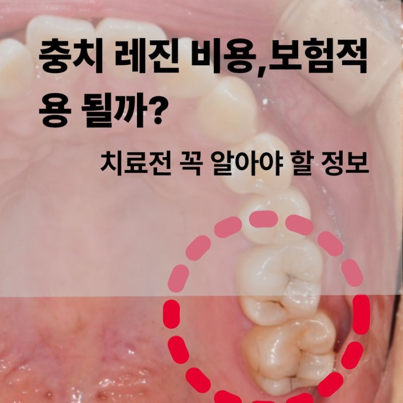 레진 비용,보험적용 될까?치료 전 꼭 알아야 할 정보
