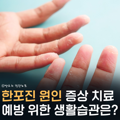 손가락가려움 물집, 한포진 증상 원인 치료법 예방법은? | 습진과 차이점