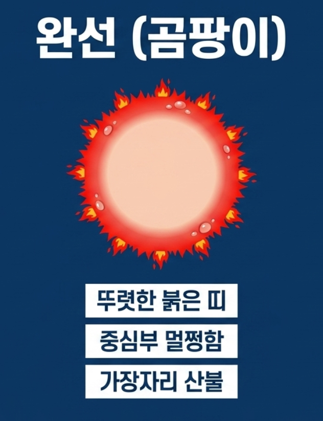 남자 고등학생 사타구니 가려움 완선 습진 차이점과 무좀약 라미실크림 올바른 사용법