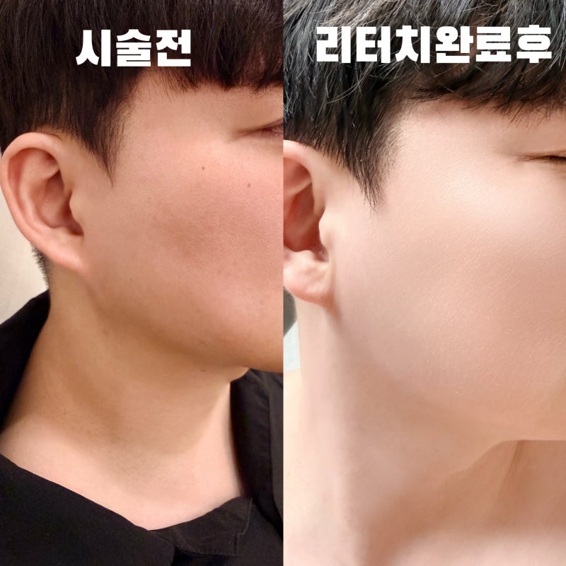 부천 상동역 편평사마귀 무제한 제거 성지 | 리터치까지 받고 드디어 끝! 최종 후기