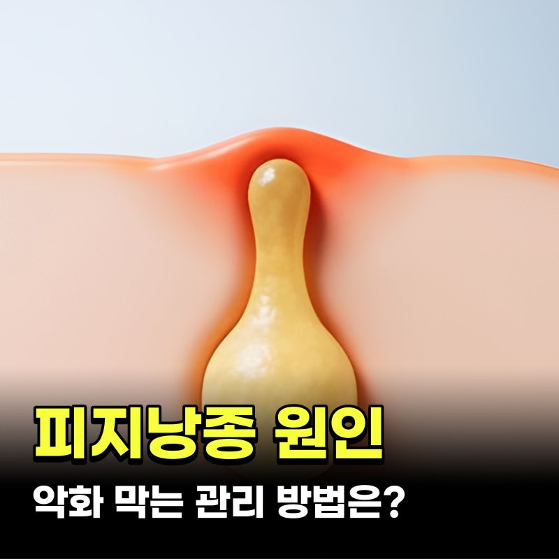 피지낭종 원인 뾰루지와 다른점 제거 방법