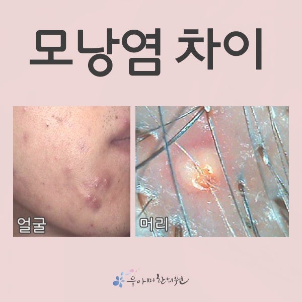 얼굴 모낭염 압출, 원장은 이렇게 결정합니다