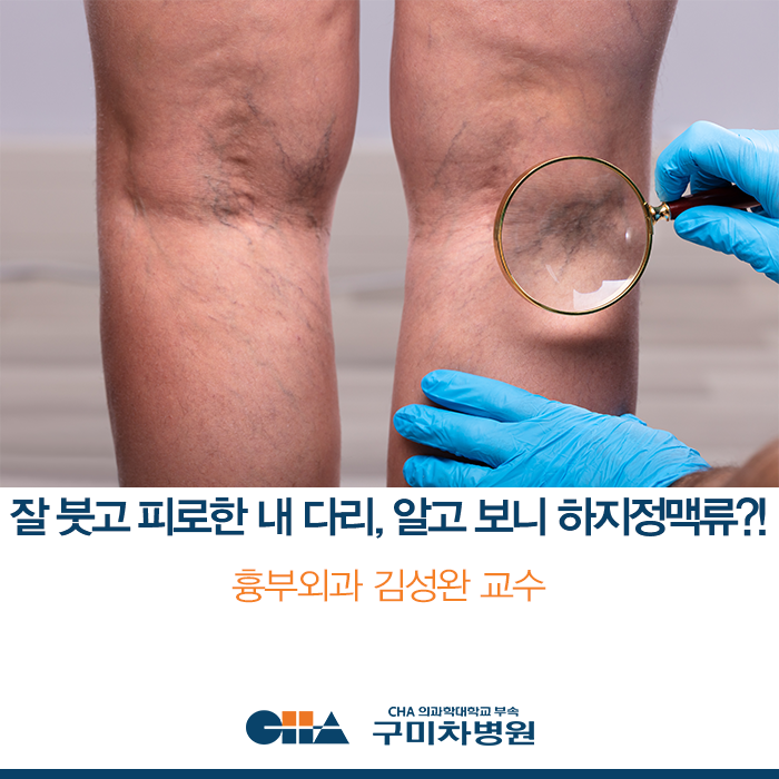 [구미차병원] 잘 붓고 피로한 내 다리, 알고 보니 하지정맥류?!_흉부외과 김성완 교수