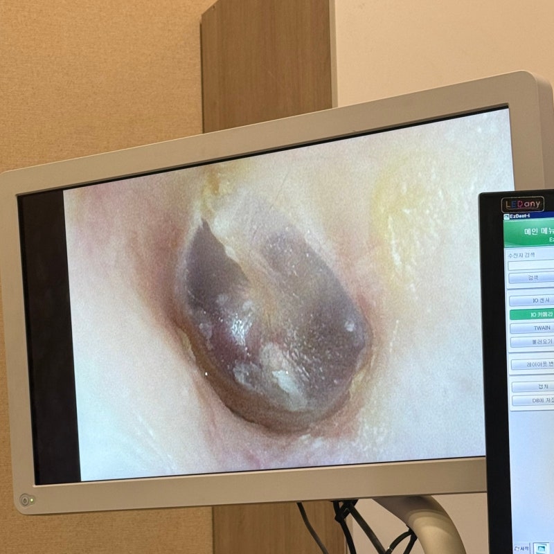 "완치후기" 외이도염 외이도진균증 완치까지 기록하려고 했는데 갑분 고막천공 ｜치료 3주차....