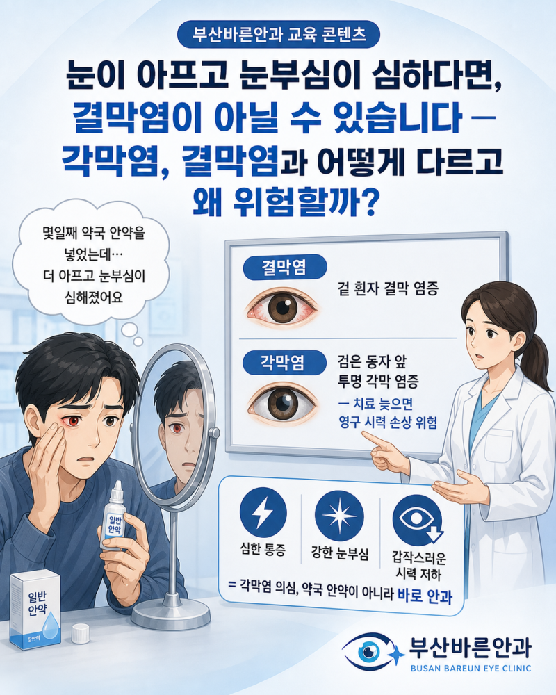 눈이 아프고 눈부심이 심하다면, 결막염이 아닐 수 있습니다— 각막염, 결막염과 어떻게 다....