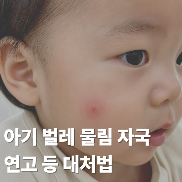 아기 벌레 물림 자국 연고 비판텐? 모기 패치? (물집, 딱딱할 때, 붓기 등 대처법)