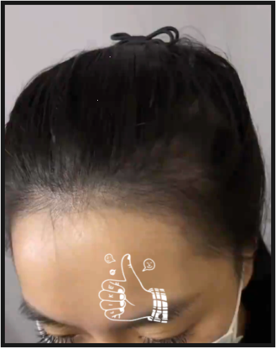 대구원형탈모병원 다녀온 김에 두피까지 잡은 솔직 후기