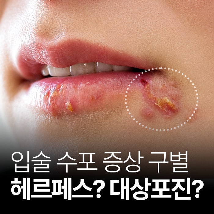 입술 수포 대상포진 헤르페스 증상 구별, 차이점 무엇일까요?