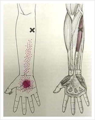 손바닥 가운데 저림