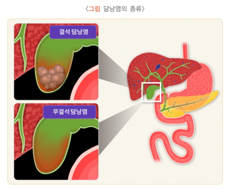 담낭염 원인 위치 역할