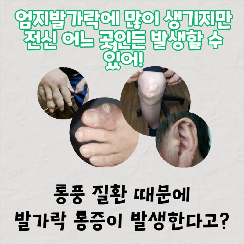 인천 중구 통풍 초기증상 발등에 나타나는 통증 원인은?