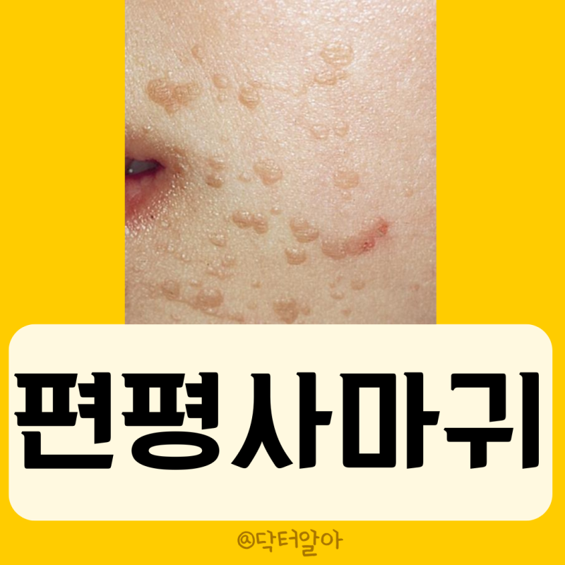 의사가 설명하는 편평사마귀 정의 증상 원인 진단 치료 예방