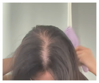 니조랄연고 두 달 발라도 도로 재발, 이것저것 헤매다 정착한 얘기
