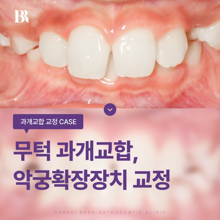 어린이 교정, 무턱 과개교합 교정 사례