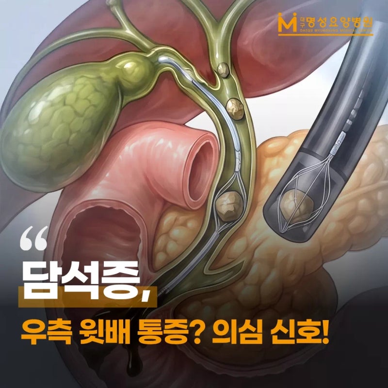 대구소화기내과 오른쪽 윗배 통증, 담석증 의심 신호 3가지