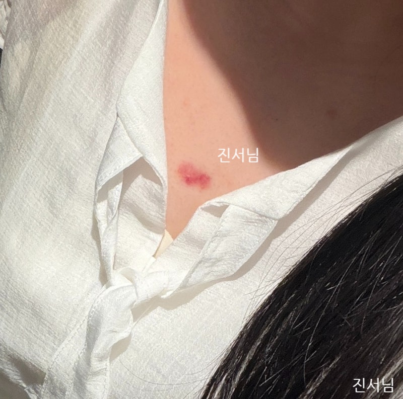 가슴 피지낭종 제거 켈로이드 흉터치료 6개월간의 치료 과정 [중간결산]