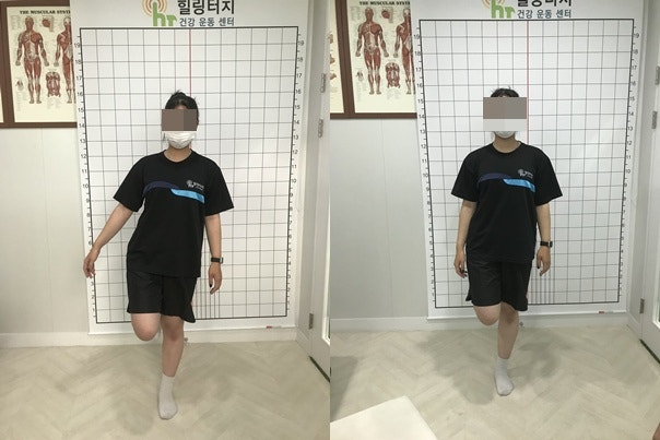 반월상연골파열 재활운동: 수술 후 재파열 막는 단계별 가이드