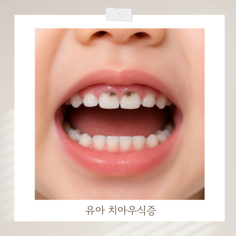 돌아기 치아우식증, 검은 점이 보인다면? 초기 증상 원인 예방법 총정리