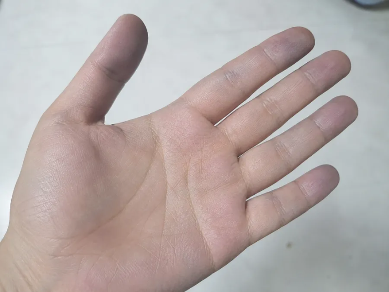 손이보내는 위험신호 손으로보는 건강신호 6가지 간질환부터 말단비대증까지 간기능 갑상선....