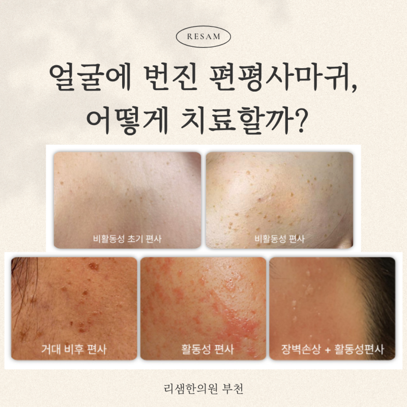 부천 편평사마귀 무제한 제거, 얼굴에 번진 사마귀 어떻게 치료할까?