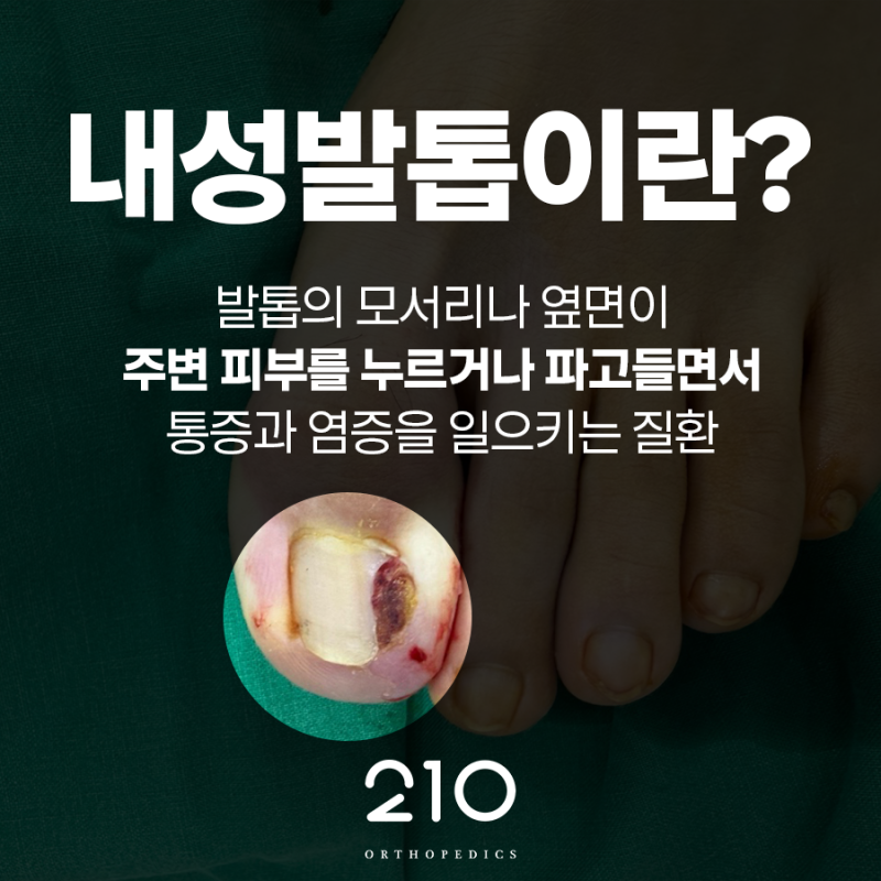 목동정형외과 내성발톱·발톱무좀, 어떻게 구분할까?