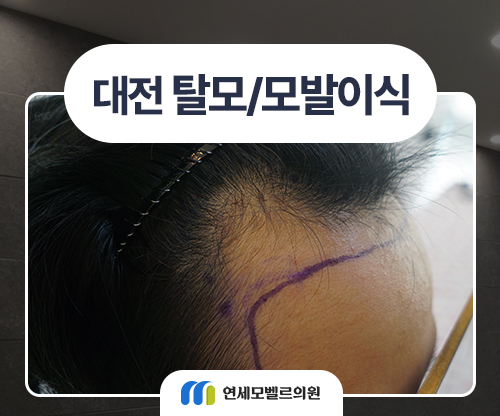 대전탈모병원 <b>모발이식</b> 비용 후기 모수별 한눈에 보기