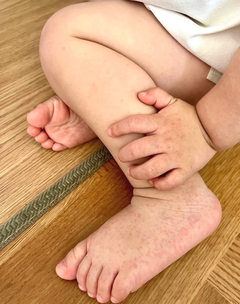 수족구 초기증상 알아야 덜아파요 잠복기 상비약 수포에 바르는 연고까지 총정리