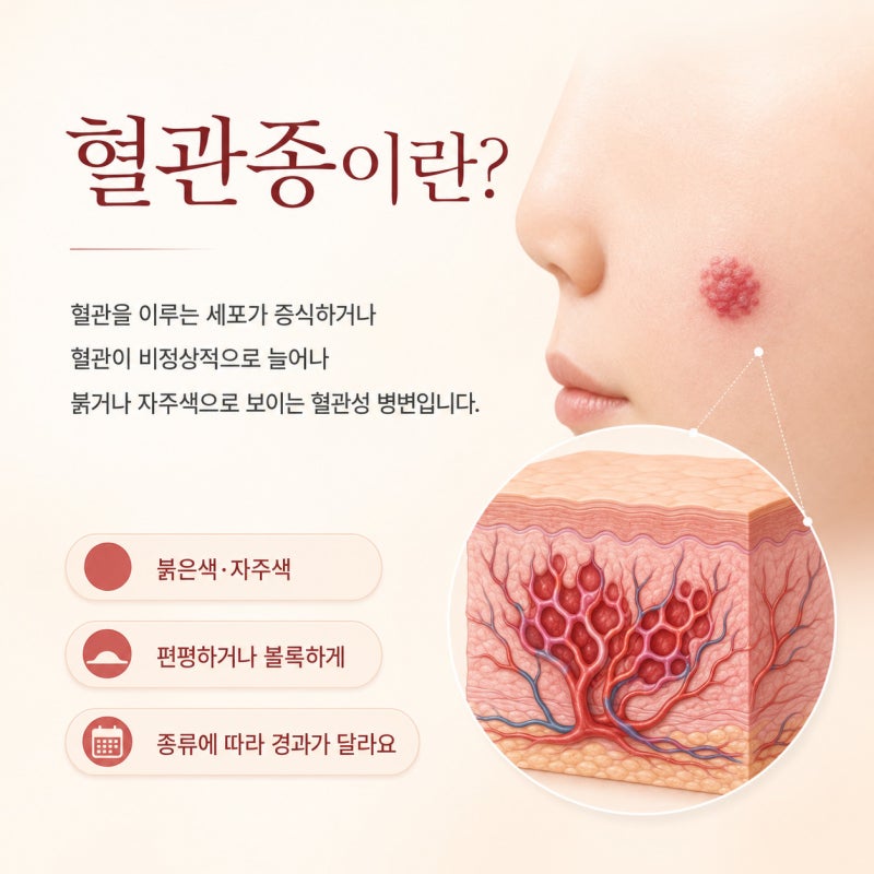 대구 혈관종 치료 브이빔퍼펙타 작용원리와 효과는
