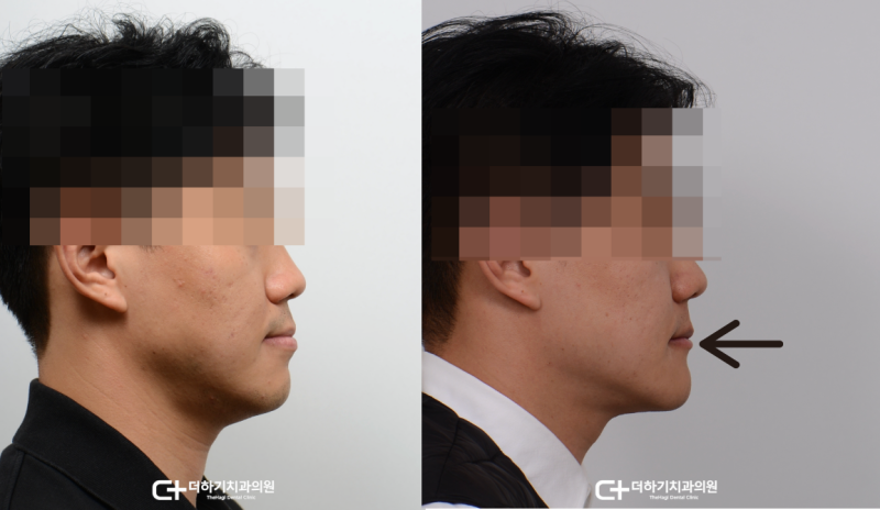 비수술주걱턱교정 후기 궁금하다면?