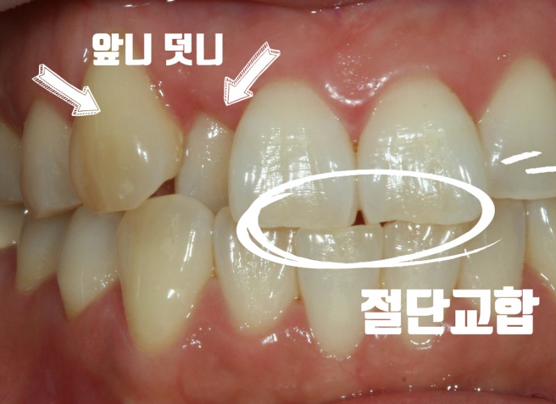 앞니교정 비용, 디지털 투명교정이 합리적인 이유