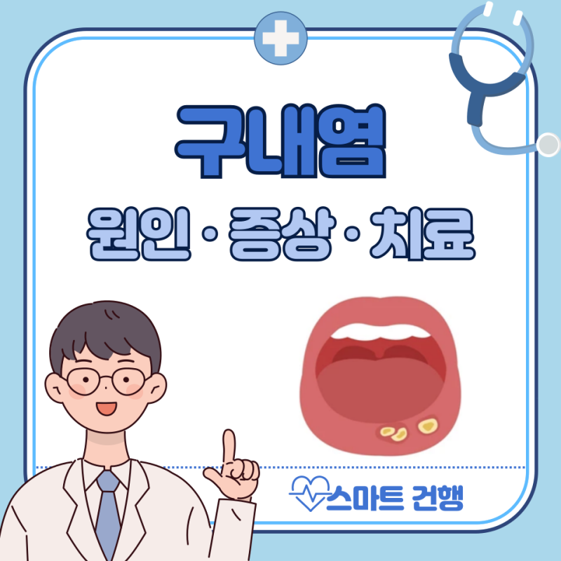 구내염 원인, 증상, 전염성, 약국 약, 연고 : 병원 어디로?