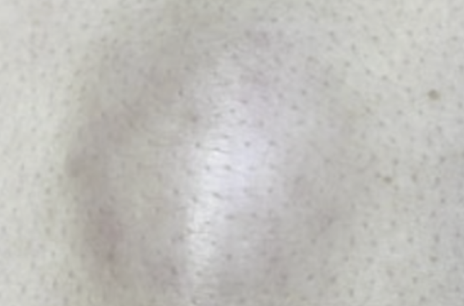 엉덩이 종기 병원 치료 어떤게 있을까?증상과 원인부터 제거 관리 방법까지