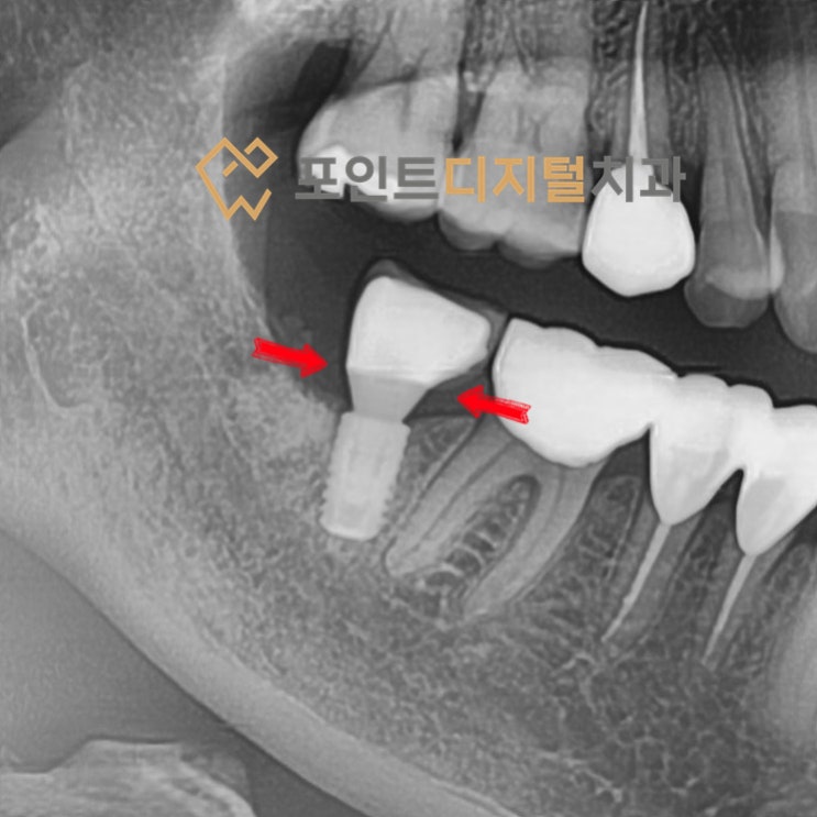 [탕정치과] 기존 타치과 임플란트 보철물도 잇몸 염증 예방하는 접착제 없는 하이니스 디지털보철로 교체 가능합니다! / 천안 아산