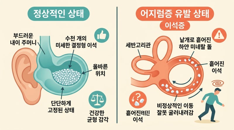 만성 어지럼증 완화를 위한 이석증 구별법과 안심 고개 회전 운동 규칙은?