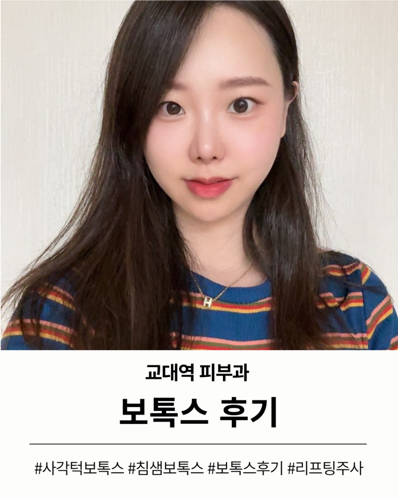 사각턱보톡스 침샘보톡스 효과 전후 비교 1차 후기