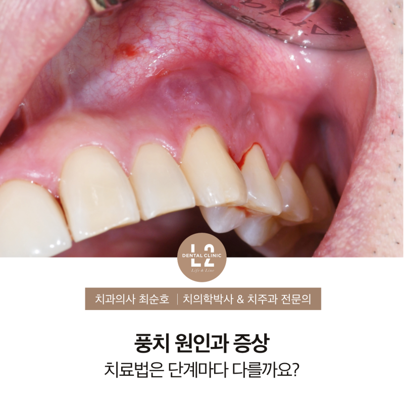 풍치 원인과 증상, 치료법은 단계마다 다를까요?