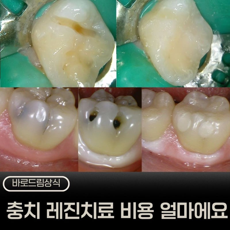치아 레진 비용 얼마인가요?