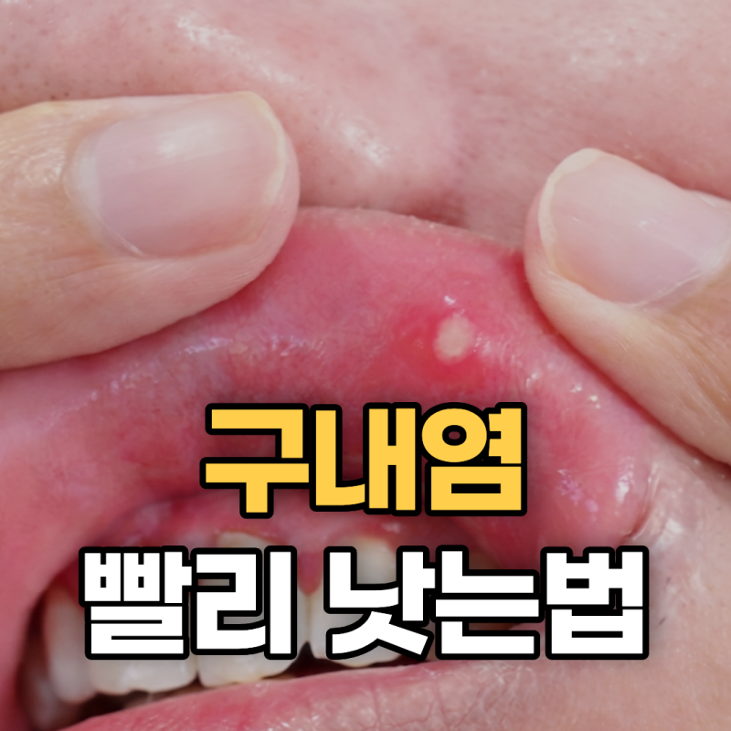 구내염 연고 패치 사용법 약국 가글로 입병 빨리 낫는법