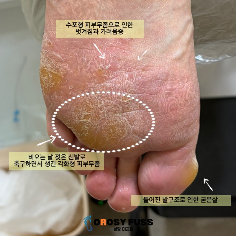 분당 발각질제거 후기. 축구로 망가진 발톱과 피부무좀, 굳은살까지 함께 관리