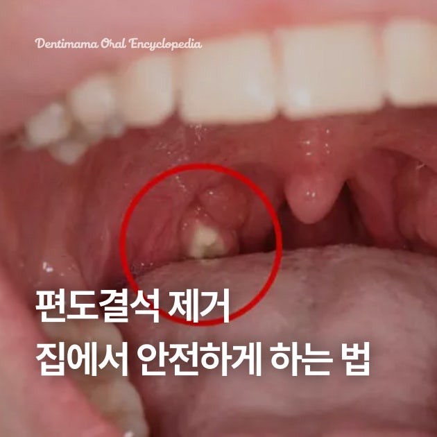 편도결석 빼는 법, 치과의사 엄마가 알려주는 안전한 셀프 관리 5가지