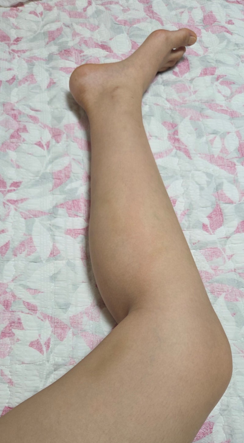하지정맥류 베나실 수술 후기 3탄
