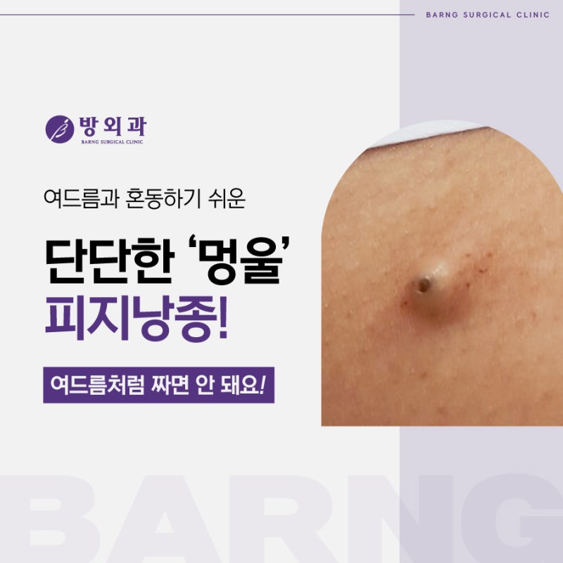 여드름과 비슷한 피지낭종, 재발 없이 깔끔히 제거하는 방법!