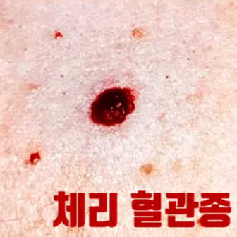 체리혈관종 빨간점, 원인 치료 비용, 화농성 육아종, 흑색종 차이