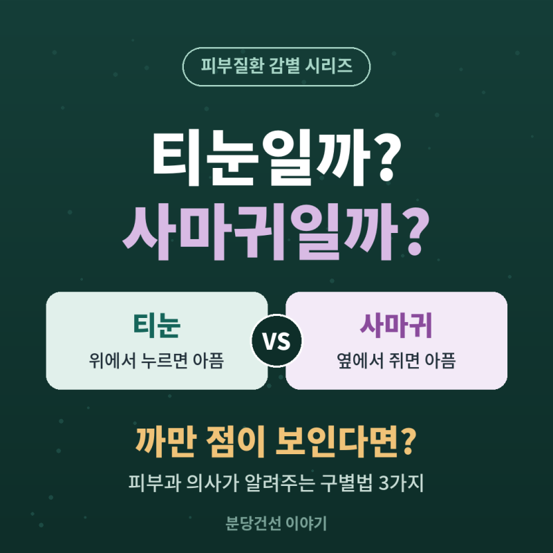 [분당 티눈 이야기-7] 발바닥 티눈일까, 사마귀일까?피부과 의사가 알려주는 구별법 3가지