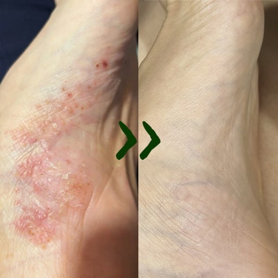 발바닥 가려움 무좀 한포진 수포 차이알고 극복 성공!